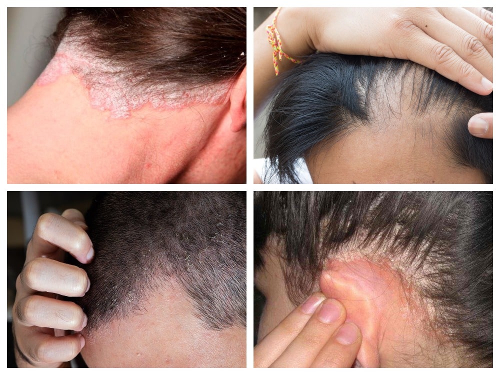 Симптомы себорейного дерматита