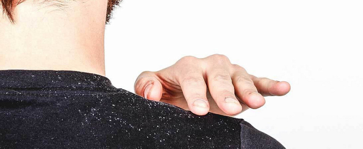 Как избавиться от сухой перхоти