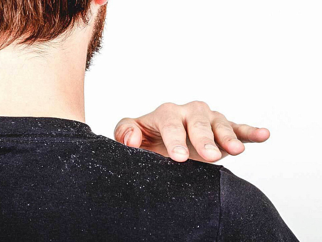 Как избавиться от сухой перхоти