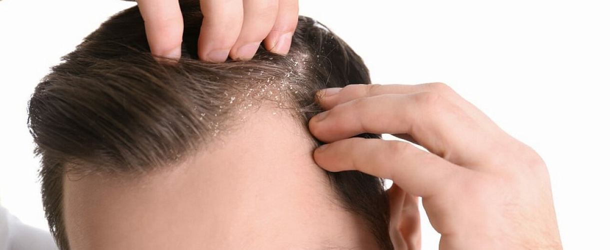 Себорейный дерматит