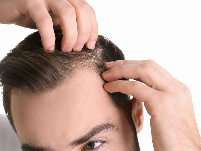 Себорейный дерматит