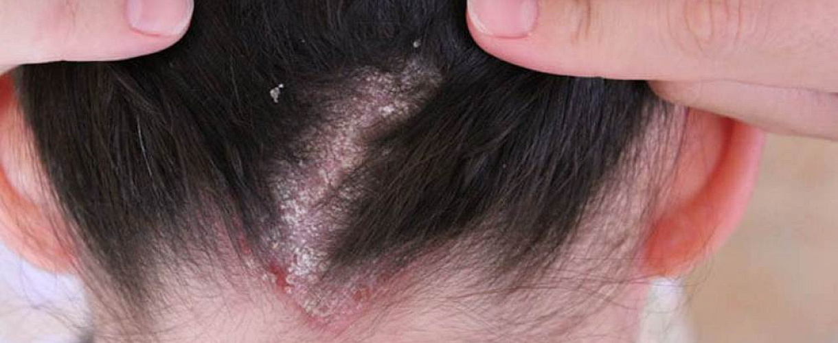 Себорейный дерматит у подростков