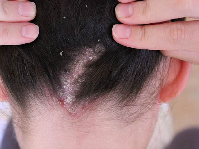 Себорейный дерматит у подростков