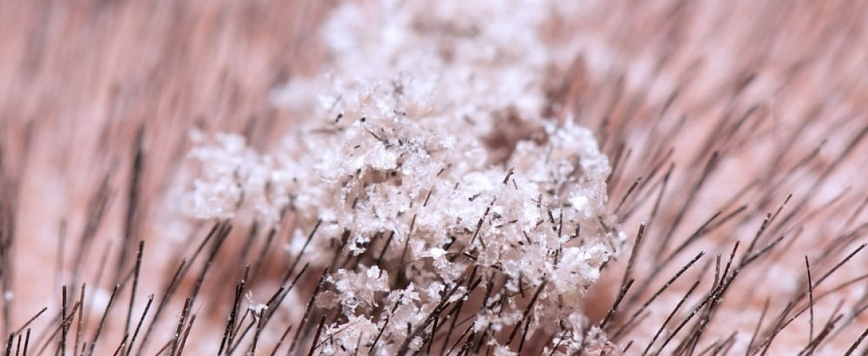 Жирная перхоть