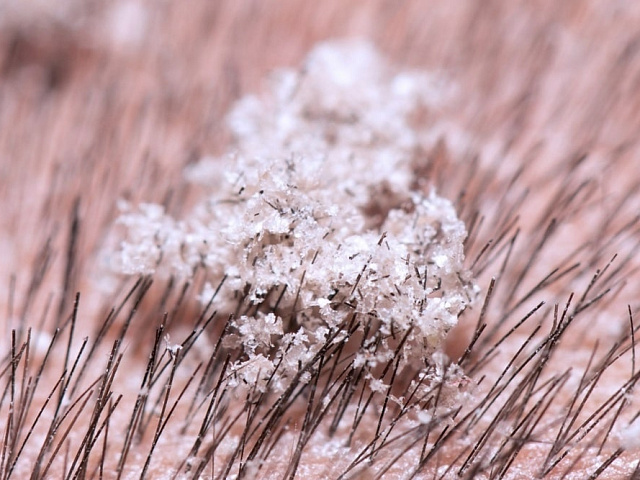 Жирная перхоть